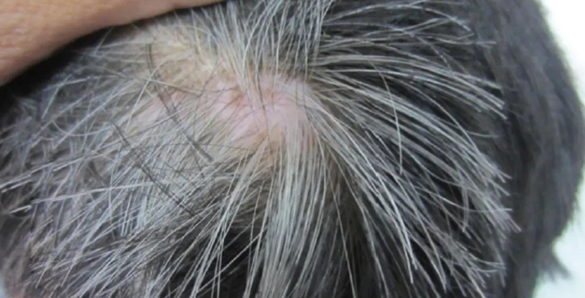 GRAY HAIR MAY BE A SIGN OF UNDERLYING DISEASE