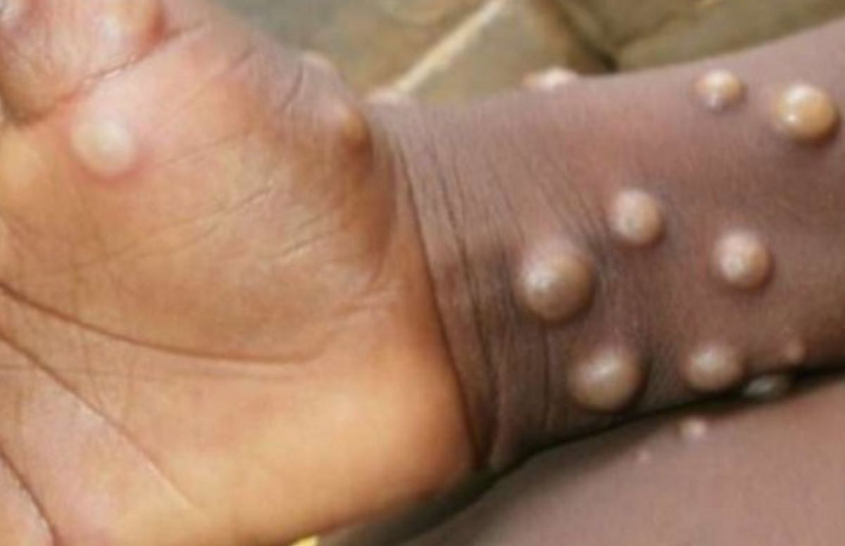 What is Monkey Pox? Symptoms & recent cases